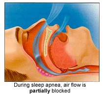 Sleep Apnea Partial